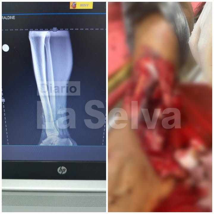 Joven resulta con el peroné expuesto tras accidente de tránsito