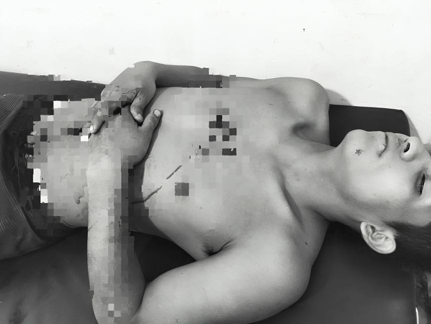 Hombre resulta gravemente herido tras ataque con arma blanca en Masusa.