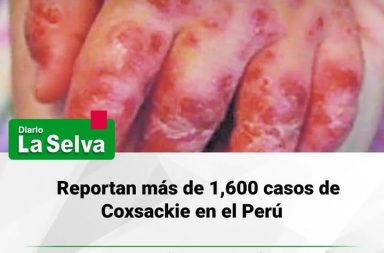 Reportan más de 1,600 casos de Coxsackie en el Perú