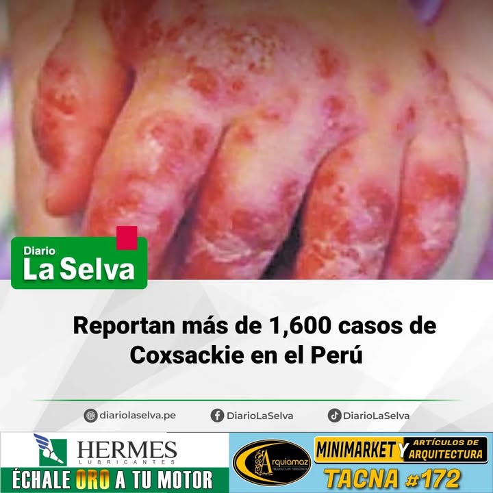 Reportan más de 1,600 casos de Coxsackie en el Perú
