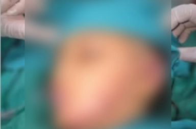 Médicos del Hospital Regional reconstruyen rostro de niña atacada por perro en Iquitos.