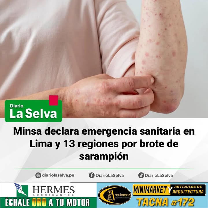Gobierno declara emergencia sanitaria por incremento de casos de sarampión