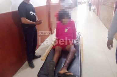 Una menor de 13 años fue trasladada de emergencia desde el kilómetro 13.5 de la carretera Iquitos–Nauta hasta el Hospital Regional, tras sufrir quemaduras de tercer grado.